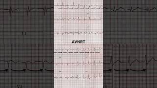 AVNRT ECG Regular and rapid rate [upl. by Ellinnet164]