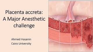 Placenta Accreta a Major anesthetic and obstetric challenge [upl. by Messing578]