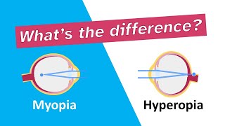 Whats the difference between myopia nearsightedness and hyperopia farsightedness [upl. by Ennagrom744]