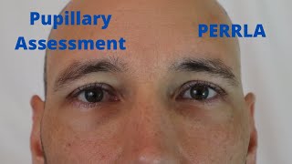 Pupillary Assessment PERRLA [upl. by Wilkens]