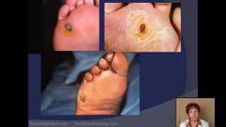 Corn amp Callus Debridement by a Podiatrist [upl. by Lucian]