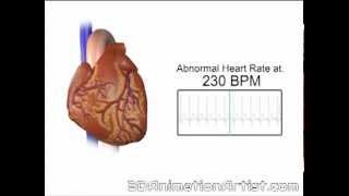 Normal Vs Accelerated Heart Rate [upl. by Brunhild]