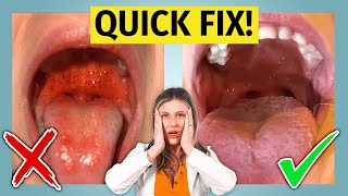 Strep Throat  treat it fast learn how [upl. by Atnohs]