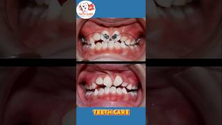 braces transformation teeth braces dental dentalcare dentalhealth dentalimplants shorts [upl. by Haskel776]