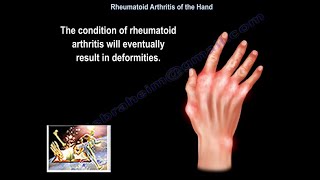 Rheumatoid Arthritis Of The Hand  Everything You Need To Know  Dr Nabil Ebraheim [upl. by Hahsi833]