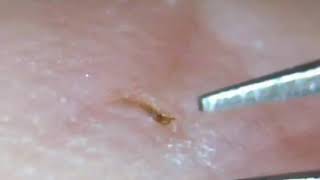 OUCH Stubborn Splinter Removed [upl. by Redford750]