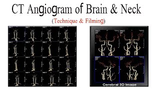 CT Angiogram of Brain and neck technique and filming [upl. by Alihs13]