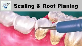 Treatment of periodontal disease  Scaling and root planing  Tartar © [upl. by Linell]