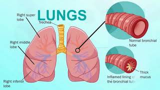 Difference Between Bronchitis and Bronchiectasis [upl. by Eagle228]