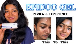 EPIDUO GEL😱💯  product Review  personal experience ♥️ [upl. by Sad]