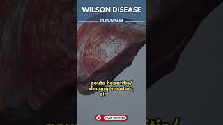 HealthByte Wilson Disease  A medical minute [upl. by Feliza]