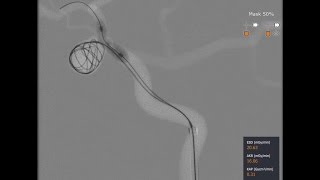 Mentice Neurovascular Brain Aneurysm Coiling Demo [upl. by Assennej560]