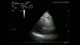 Echo Evaluation Of Cardiomyopathies Dr Rakesh Gupta [upl. by Haropizt]