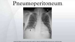 Pneumoperitoneum [upl. by Enier]