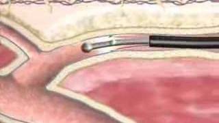 Varicose Veins Closure Procedure at BIDMC [upl. by Remington]