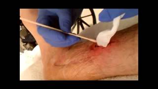 Wound Care Packing  YouTube [upl. by Anoed150]