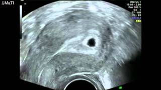 Early pregnancy scan  ultrasound 5 weeks gestation [upl. by Atekram654]