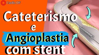 CATETERISMO e ANGIOPLASTIA COM STENT saiba tudo 2021 [upl. by Amat]