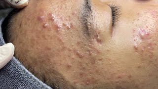 ACNE TREATMENT VU QUYNH MI  Perennial Blackheads On Boy Face 2024FULL [upl. by Barney]