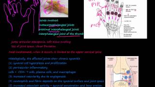 93P What is Rheumatoid Arthritis RA morphology prevalence pannus Rheumatoid nodules [upl. by Nonnarb934]