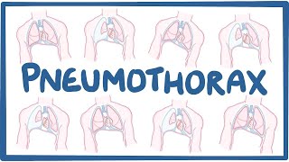 Pneumothorax  causes symptoms diagnosis treatment pathology [upl. by Abert]