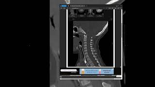 Atlantooccipital dissociation [upl. by Litt]