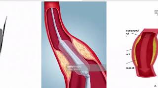 treatment of chronic ischemia [upl. by Reckford]