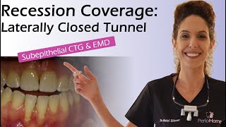 Recession Coverage Laterally Closed Tunnel wtih Subepithelial CTG EMD [upl. by Ebert]