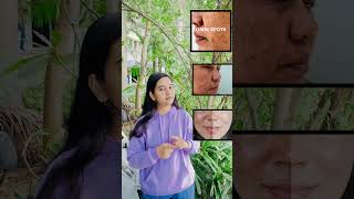 Kojic Acid Cream review Pigmentation  Acne prone  Skin Whitening kojicacid skincare kojicsoap [upl. by Ahsenyt]