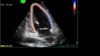 ABNORMAL STRAIN LONGITUDINAL ECHO [upl. by Clapp]