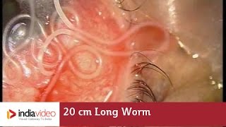 20 cm Long Worm In The Human Eye First Ever Recorded On Video  India Video [upl. by Flanigan]