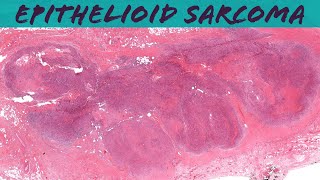 Epithelioid Sarcoma dont confuse with rheumatoid nodule or granuloma annulare Oregon Case 10 [upl. by Isaacson977]