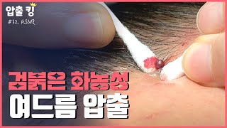 압출킹 32 검붉은 화농성 여드름 압출 ASMR 🩸시원함 주의🩸 [upl. by Arv]