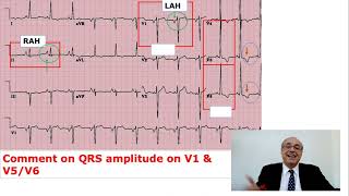 EKG Trainer Case 5 Answer [upl. by Yerffej]