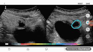 Urachal cyst on ultrasound [upl. by Panthea]