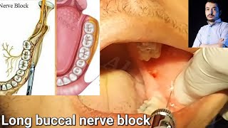 Local Anesthesia Long Buccal Nerve Block Technique Mandibular Anesthesia techniques dentistry [upl. by Elvira]