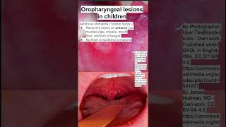 Oropharyngeal lesions in children [upl. by Niccolo]