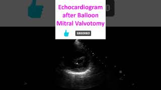 Echocardiogram after Balloon Mitral Valvotomy [upl. by Bumgardner]