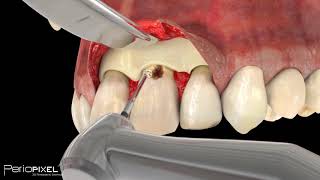 Avance vídeo completo quotCaries Subgingivalquot  PerioPixel [upl. by Mail]