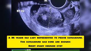 Dermoid cyst ✨ [upl. by Larry]