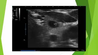 Colloïde versus calcification en échographie thyroïdienne [upl. by Hares]