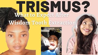 Jaw Lock My Wisdom Tooth Removal HORROR STORY  What to Expect  Know  TRISMUS [upl. by Illoh613]