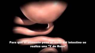 Bypass gastrico laparoscopico 2wmv [upl. by Naihtsirc288]