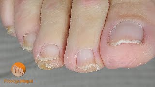 Comfort returns to tired feet  Podological cleaning of toenails and calluses Podología Integral [upl. by Janine149]