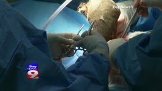 Doctors remove a fourpound what [upl. by Wattenberg]