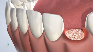 PostOperative Instructions Following Bone Grafting Surgery  Oral Surgery [upl. by Nairadal]