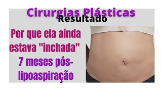 Cirurgias plasticas resultados por que após 7 meses da lipoaspiração ela ainda estava inchada [upl. by Muriah]