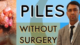 PILES TREATMENT  WITHOUT SURGERY [upl. by Jessamine]