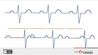 clinic evaluation and investigation for bradycardia Dr Hany Samir [upl. by Ligriv662]