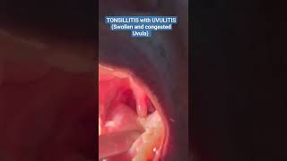 The ULTIMATE VIEW of TONSILLITIS with UVULITIS Watch Now shorts short viral trending [upl. by Schwab]